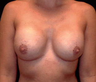 Case--1380 | After Breast Cancer Reconstruction