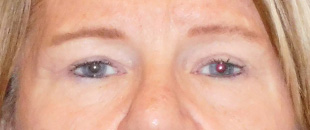 Case--4473 | After Blepharoplasty