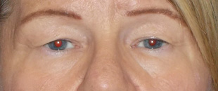 Case--4473 | Before Blepharoplasty