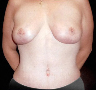 Case--8621 | After Abdominoplasty