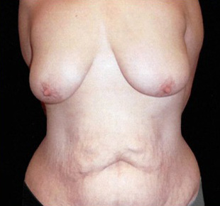 Case--8621 | Before Abdominoplasty