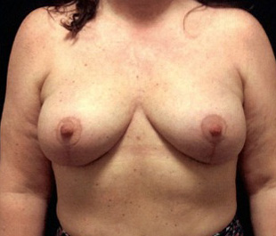 Case--7289 | After Breast Lift