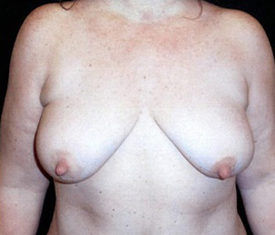 Case--7289 | Before Breast Lift