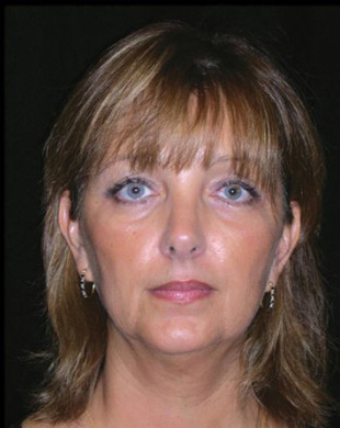 Case--8295 | Before Mini Facelift