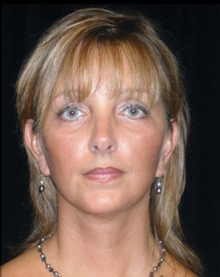 Case--8295 | After Mini Facelift