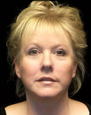 Case--8803 | After Mini Facelift