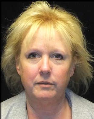 Case--8803 | Before Mini Facelift