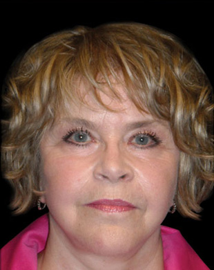 Case--6146 | After Mini Facelift