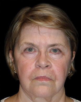 Case--6146 | Before Mini Facelift