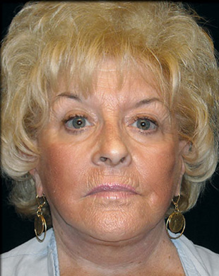 Case--7370 | After Mini Facelift