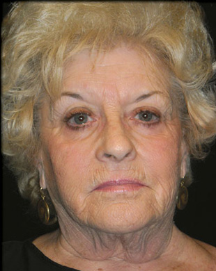 Case--7370 | Before Mini Facelift