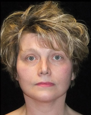 Case--8494 | After Mini Facelift