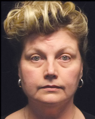 Case--8494 | Before Mini Facelift