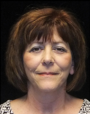 Case--1298 | After Mini Facelift