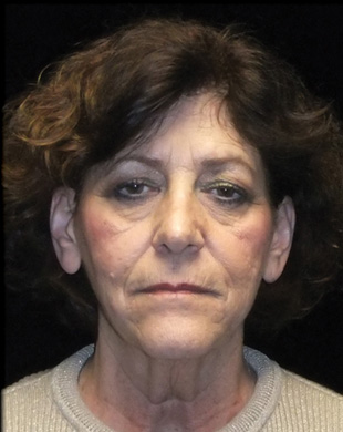 Case--1298 | Before Mini Facelift