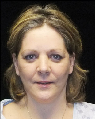 Case--2349 | After Mini Facelift