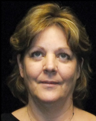 Case--2349 | Before Mini Facelift