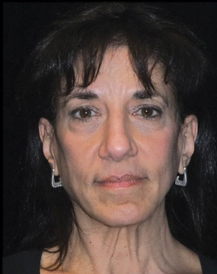 Case--5415 | Before Mini Facelift