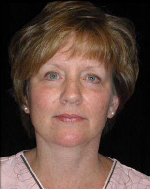 Case--4947 | After Mini Facelift