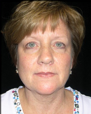 Case--4947 | Before Mini Facelift