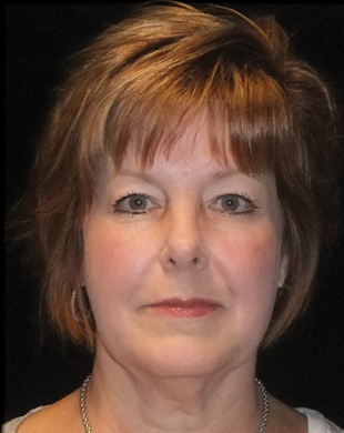 Case--9325 | Before Mini Facelift