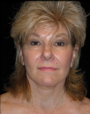 Case--3971 | After Mini Facelift