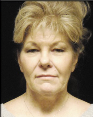 Case--3971 | Before Mini Facelift