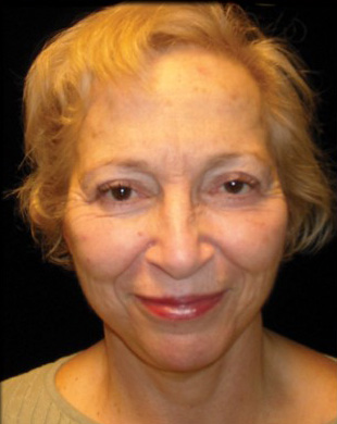 Case--8945 | After Mini Facelift