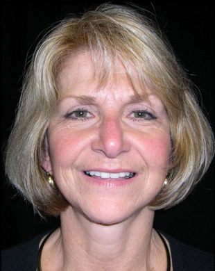 Case--9613 | After Mini Facelift