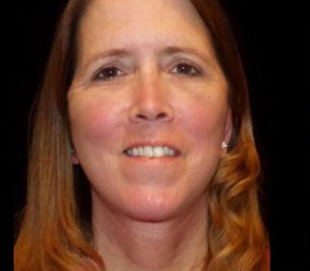 Case--7416 | After Mini Facelift