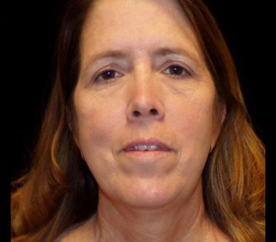 Case--7416 | Before Mini Facelift