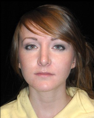 Case--1253 | After Rhinoplasty