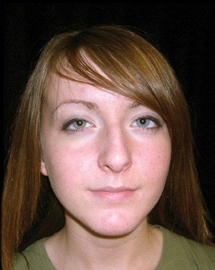 Case--1253 | Before Rhinoplasty