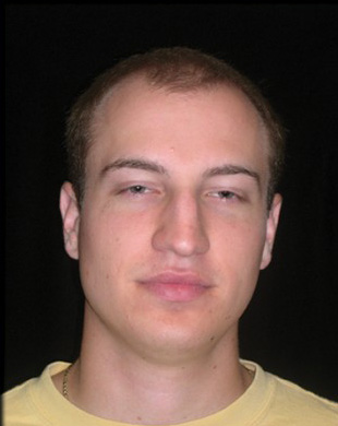 Case--7625 | Before Rhinoplasty