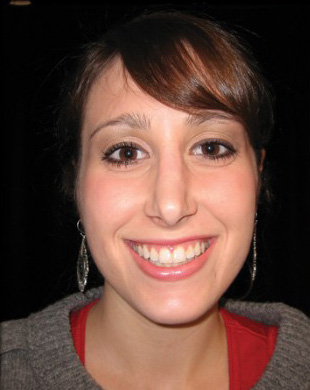 Case--9396 | After Rhinoplasty