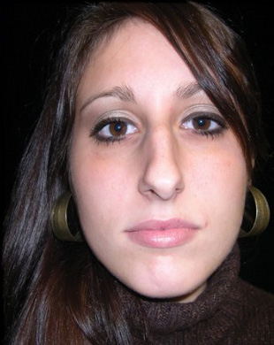 Case--9396 | Before Rhinoplasty