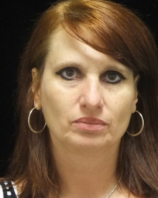 Case--9893 | Before Rhinoplasty