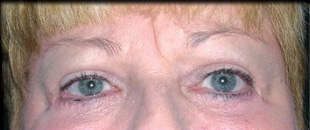 Case--2173 | After Blepharoplasty