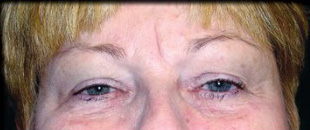 Case--2173 | Before Blepharoplasty