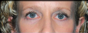 Case--1129 | After Blepharoplasty