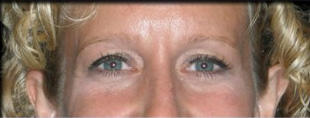 Case--1129 | Before Blepharoplasty