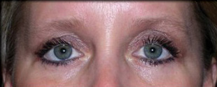 Case--2933 | After Blepharoplasty