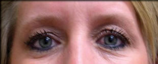 Case--2933 | Before Blepharoplasty